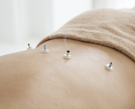 Women who have laid the moxibustion on the back